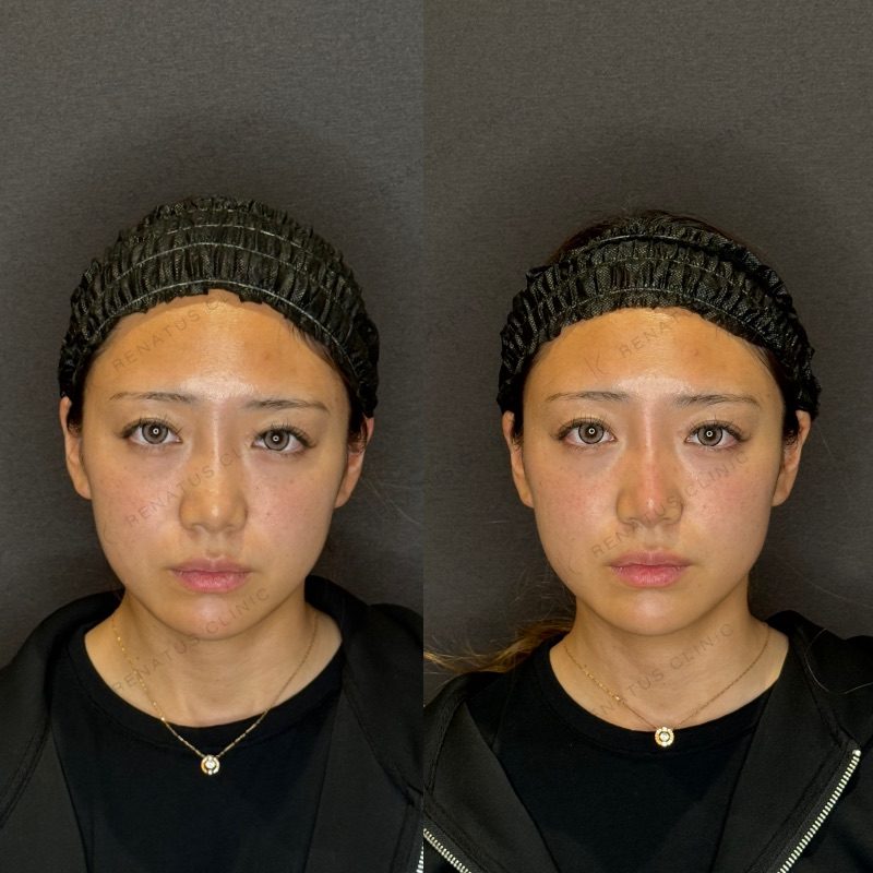 鼻ヒアルロン酸の症例（ボラックス・20代女性）。注入前と注入後の比較