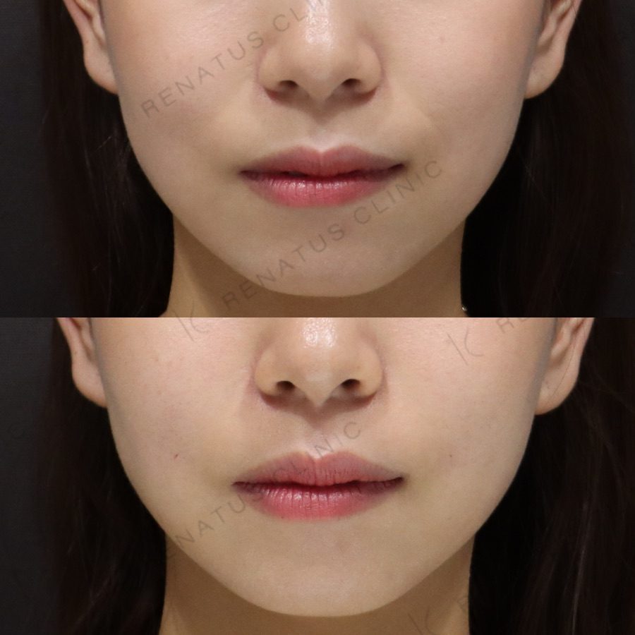 ためしてガッテンのほうれい線の消し方は効く?顔のたるみ改善を美容皮膚科医が解説 28 ほうれい線ヒアルロン酸の症例(ボリフト・30代女性)。注入前と注入後の比較