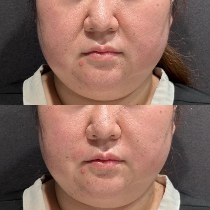 ためしてガッテンのほうれい線の消し方は効く?顔のたるみ改善を美容皮膚科医が解説 23 ほうれい線ヒアルロン酸の症例(ボリフト・30代女性)。注入前と注入後の比較