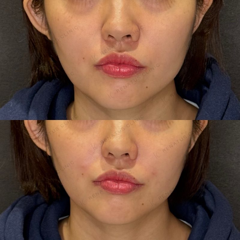 ためしてガッテンのほうれい線の消し方は効く?顔のたるみ改善を美容皮膚科医が解説 22 ほうれい線ヒアルロン酸の症例(ボリフト・20代女性)。注入前と注入後の比較