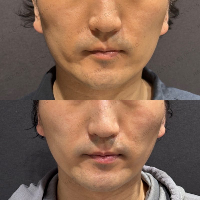 糸リフトの症例（糸リフト・30代男性）。施術前と施術後の比較