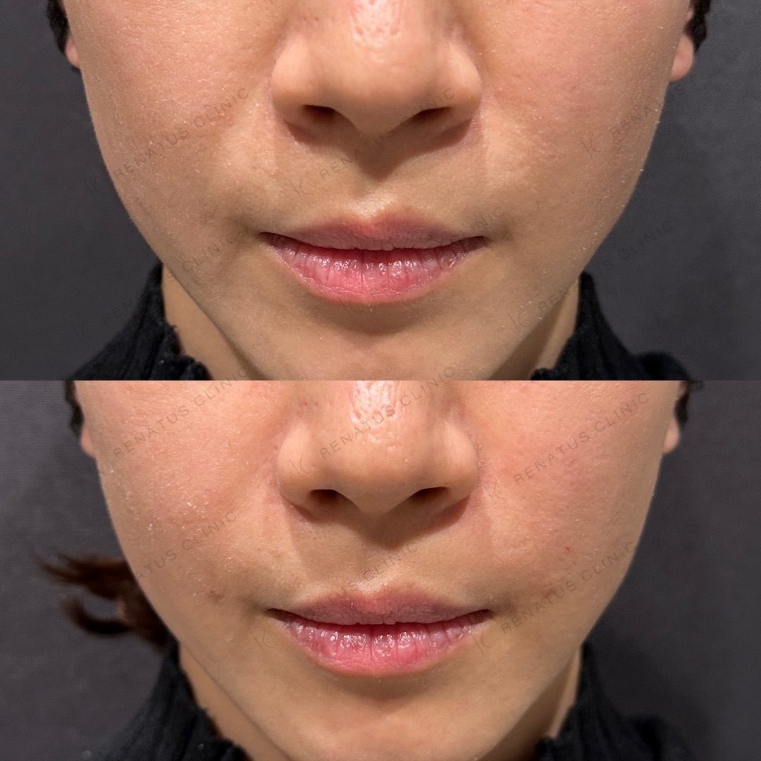 ためしてガッテンのほうれい線の消し方は効く?顔のたるみ改善を美容皮膚科医が解説 21 ほうれい線ヒアルロン酸の症例(ボリフト・30代女性)。注入前と注入後の比較
