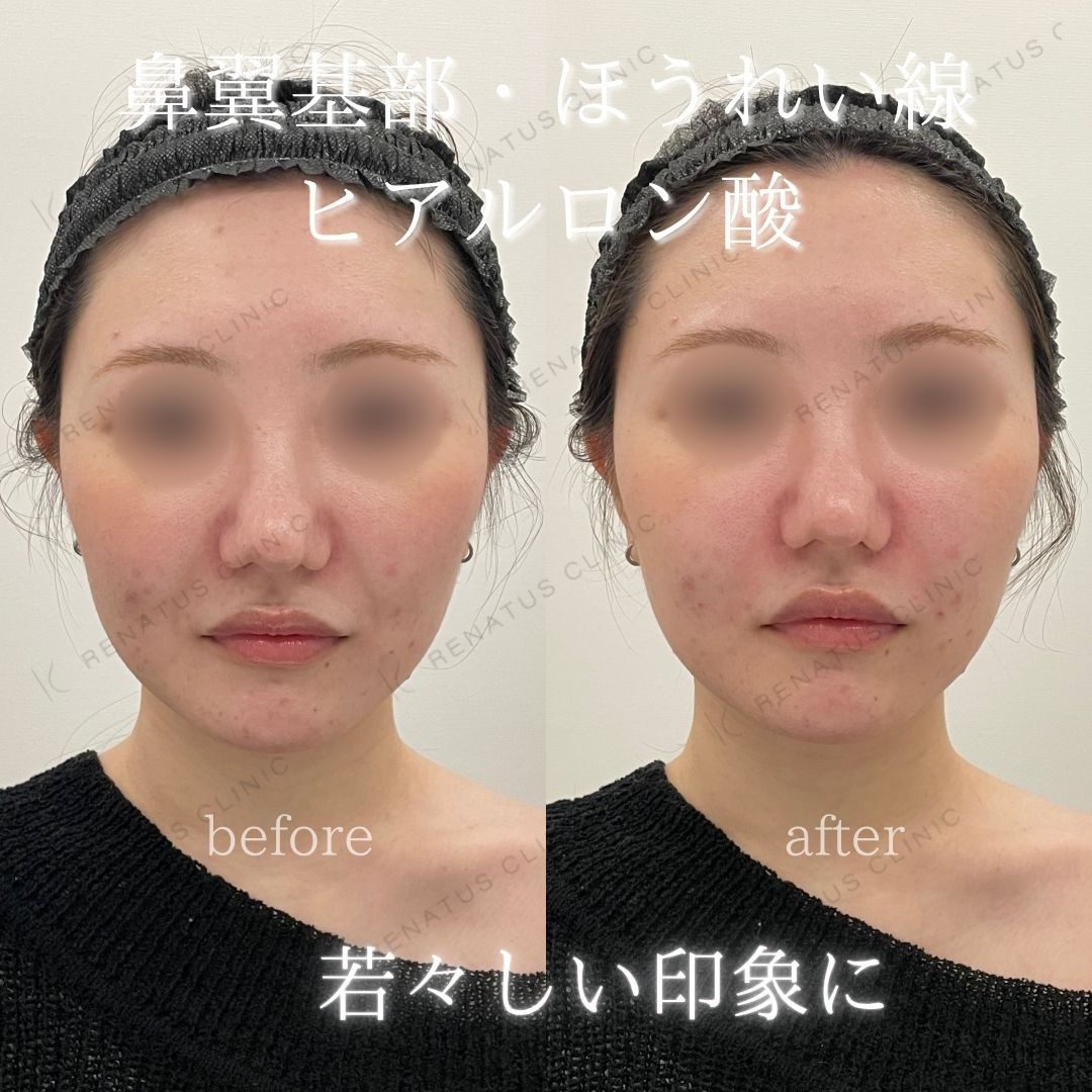 大阪のほうれい線ヒアルロン酸が上手い先生・名医と安いおすすめの専門クリニック 83 ほうれい線ヒアルロン酸の症例(ボリフト・20代女性)。注入前と注入後の比較