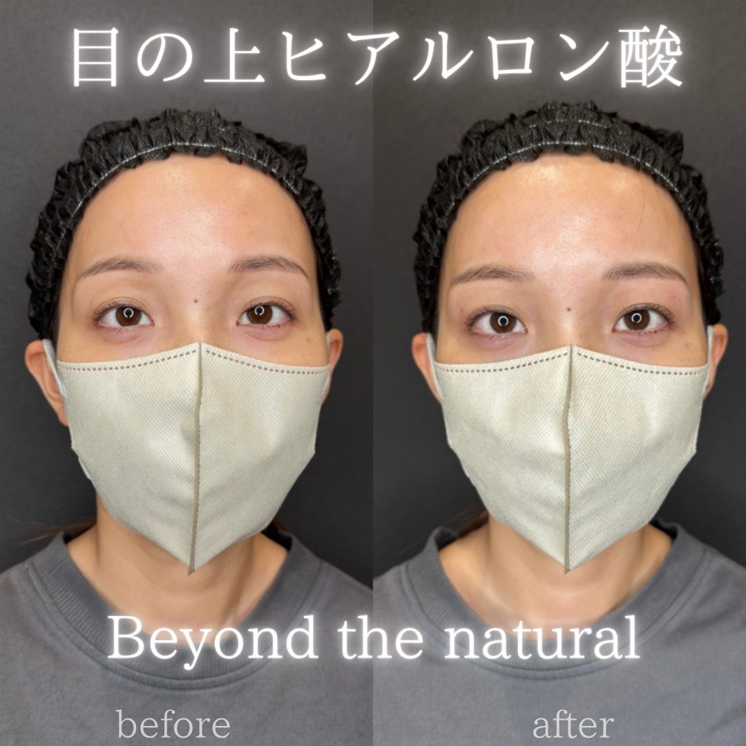 目の上（目のくぼみ）ヒアルロン酸の症例（ボルベラ・30代女性）。注入前と注入後の比較