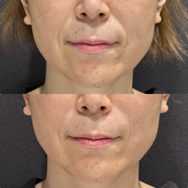 大阪のほうれい線ヒアルロン酸が上手い先生・名医と安いおすすめの専門クリニック 79 ほうれい線ヒアルロン酸の症例(ボリフト・40代女性)。注入前と注入後の比較