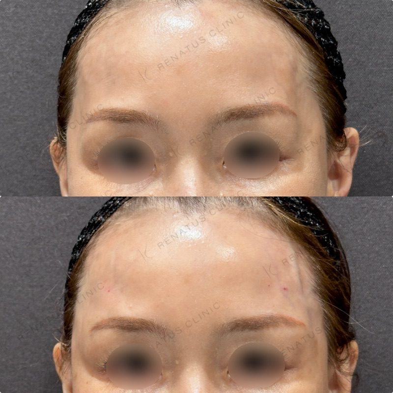 こめかみのヒアルロン酸注入 11 こめかみヒアルロン酸の症例(ボリューマ・50代女性)。注入前と注入後の比較