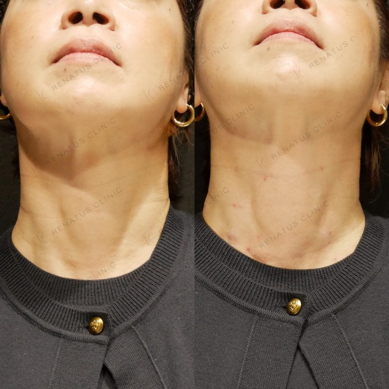 スキンバイブとは(SKINVIVE)|効果・料金・ダウンタイム・副作用を専門医が解説【レナトゥスクリニック】 19 ボライト(スキンバイブ)の症例(ボライト・50代女性)。注入前と注入後の比較