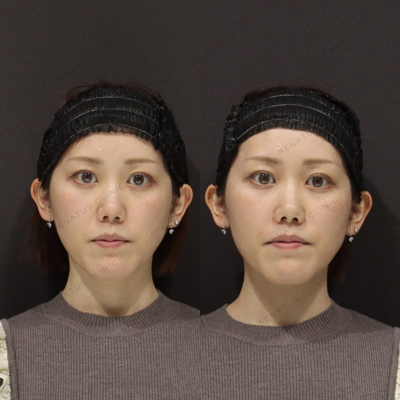 大阪のほうれい線ヒアルロン酸が上手い先生・名医と安いおすすめの専門クリニック 67 ほうれい線ヒアルロン酸の症例(ボリフト・30代女性)。注入前と注入後の比較