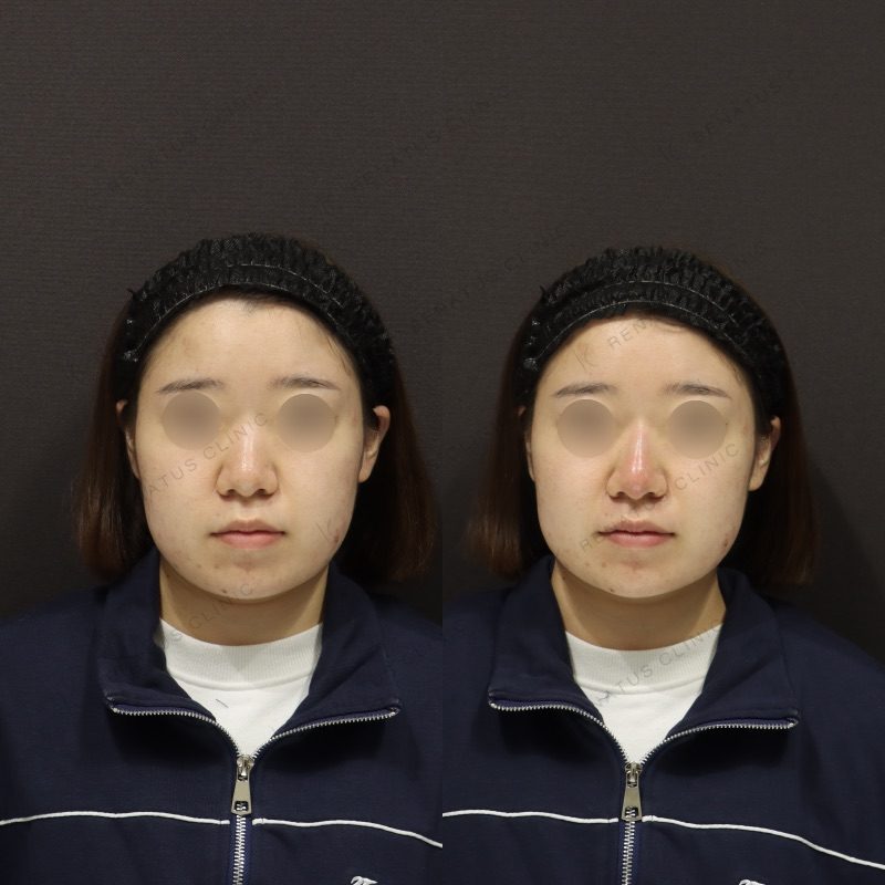 鼻ヒアルロン酸の症例（ボラックス・20代女性）。注入前と注入後の比較