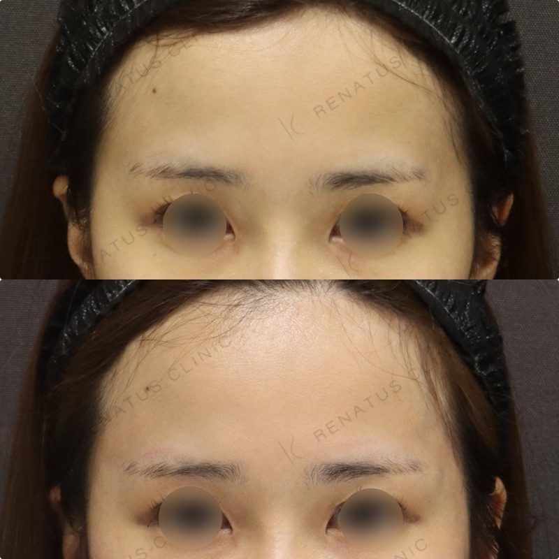 こめかみのヒアルロン酸注入 10 こめかみヒアルロン酸の症例(ボリューマ・30代女性)。注入前と注入後の比較