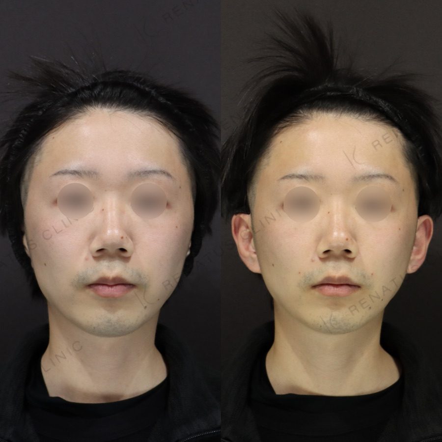 大阪のほうれい線ヒアルロン酸が上手い先生・名医と安いおすすめの専門クリニック 64 ほうれい線ヒアルロン酸の症例(ボリフト・30代女性)。注入前と注入後の比較