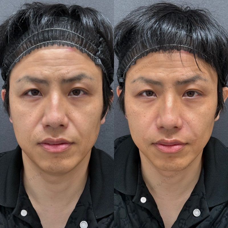 大阪のほうれい線ヒアルロン酸が上手い先生・名医と安いおすすめの専門クリニック 58 ほうれい線ヒアルロン酸の症例(ボリフト・40代男性)。注入前と注入後の比較