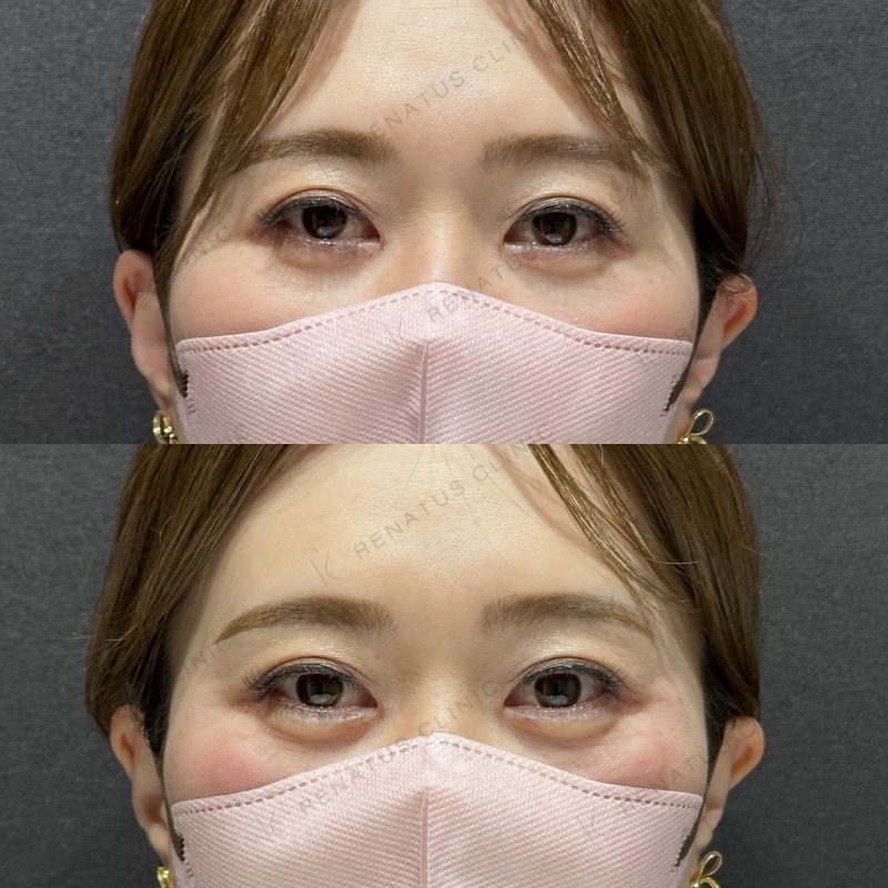涙袋ヒアルロン酸の症例（ボルベラ・50代女性）。注入前と注入後の比較