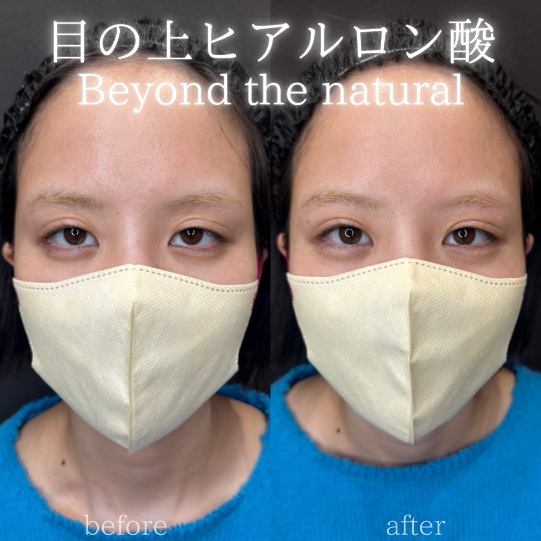目の上（目のくぼみ）ヒアルロン酸の症例（ボルベラ・20代女性）。注入前と注入後の比較
