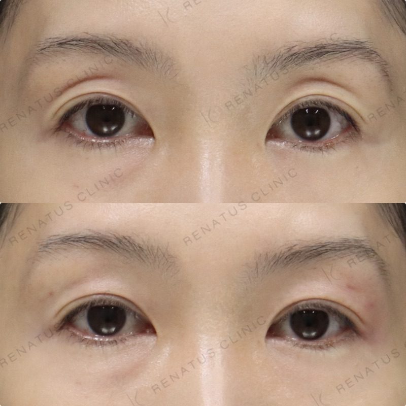 目のくぼみ・目の上のくぼみ ヒアルロン酸の費用・何cc・持ち|名医の選び方 59 目の上(目のくぼみ)ヒアルロン酸の症例(ボルベラ・30代女性)。注入前と注入後の比較