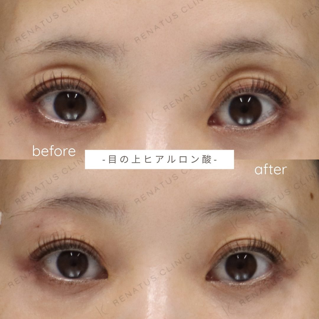 目のくぼみ・目の上のくぼみ ヒアルロン酸の費用・何cc・持ち|名医の選び方 58 目の上(目のくぼみ)ヒアルロン酸の症例(ボルベラ・30代女性)。注入前と注入後の比較