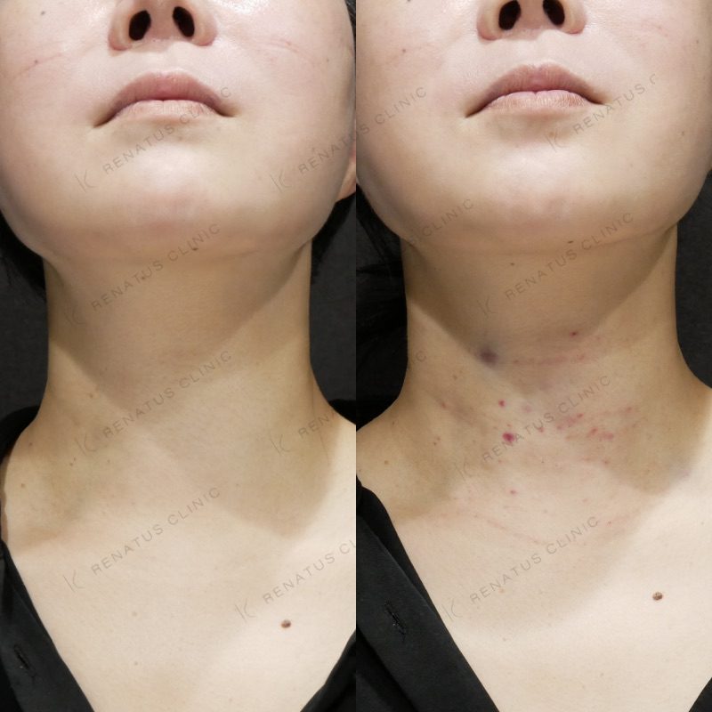 スキンバイブとは(SKINVIVE)|効果・料金・ダウンタイム・副作用を専門医が解説【レナトゥスクリニック】 18 ボライト(スキンバイブ)の症例(ボライト・40代女性)。注入前と注入後の比較