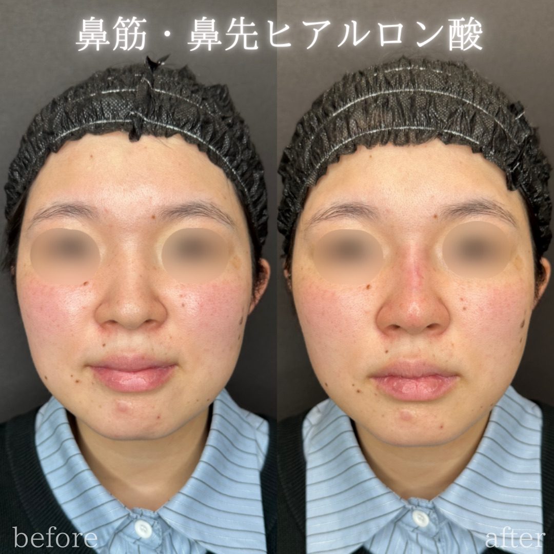 鼻ヒアルロン酸の症例（ボラックス・20代女性）。注入前と注入後の比較