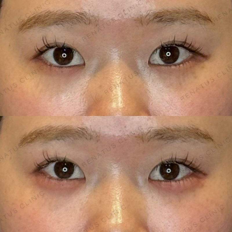 涙袋ヒアルロン酸の症例（ボルベラ・20代女性）。注入前と注入後の比較