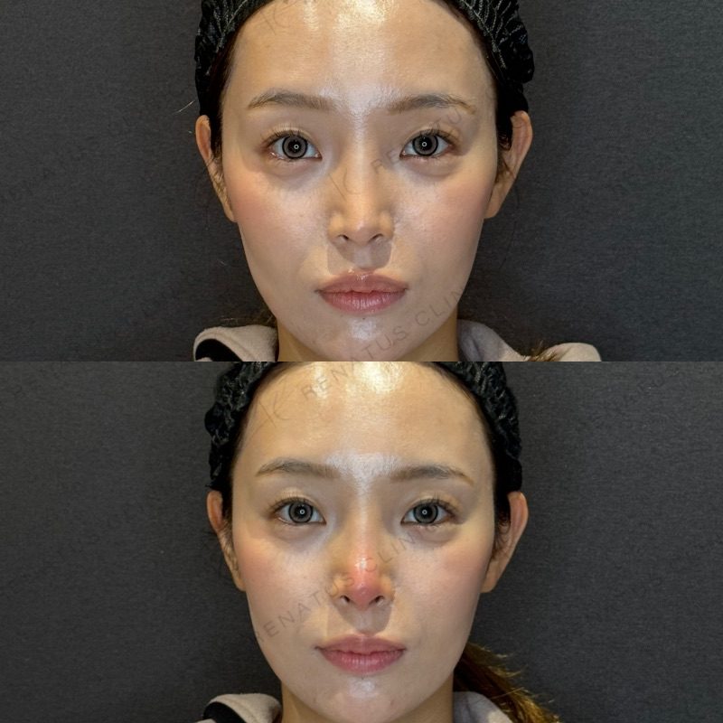 鼻ヒアルロン酸の症例（ボラックス・20代女性）。注入前と注入後の比較