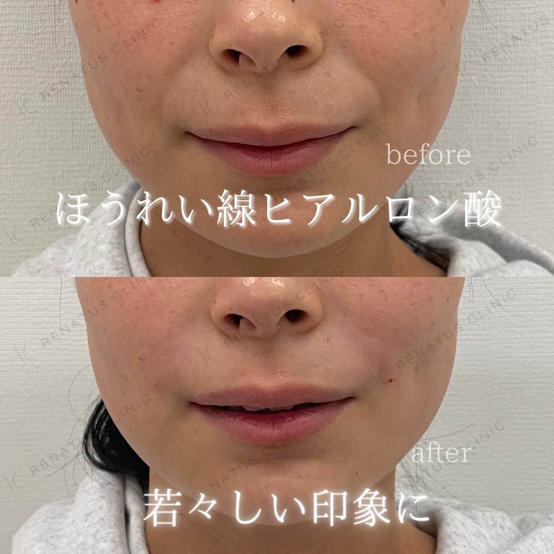 大阪のほうれい線ヒアルロン酸が上手い先生・名医と安いおすすめの専門クリニック 54 ほうれい線ヒアルロン酸の症例(ボリフト・30代女性)。注入前と注入後の比較
