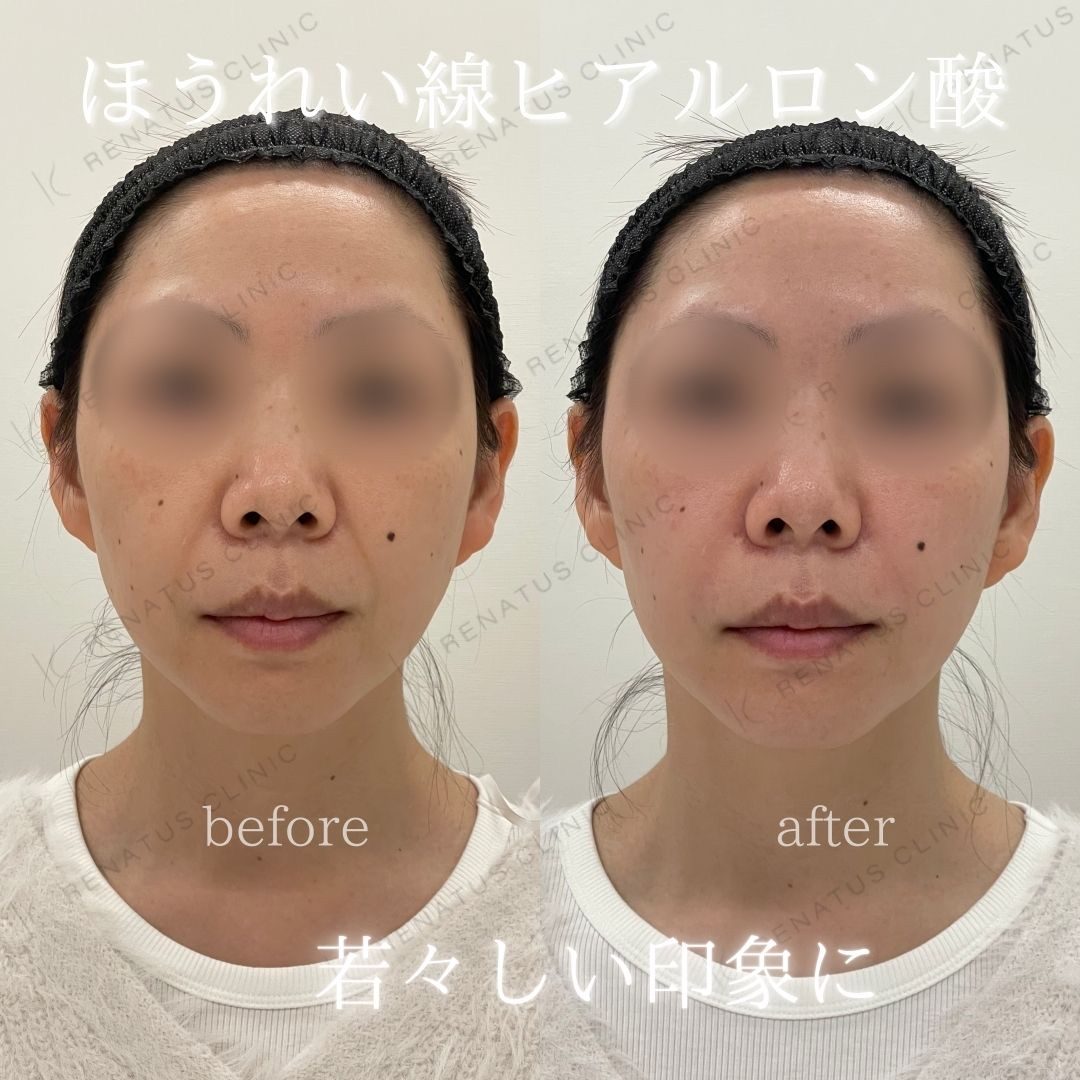 大阪のほうれい線ヒアルロン酸が上手い先生・名医と安いおすすめの専門クリニック 53 ほうれい線ヒアルロン酸の症例(ボリフト・40代女性)。注入前と注入後の比較
