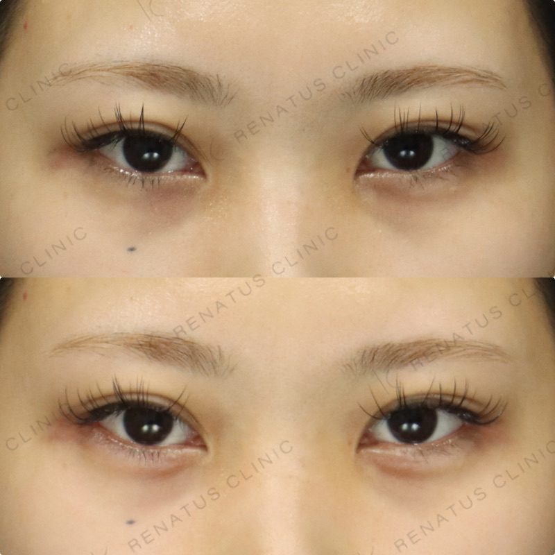 涙袋ヒアルロン酸の症例（ボルベラ・20代女性）。注入前と注入後の比較