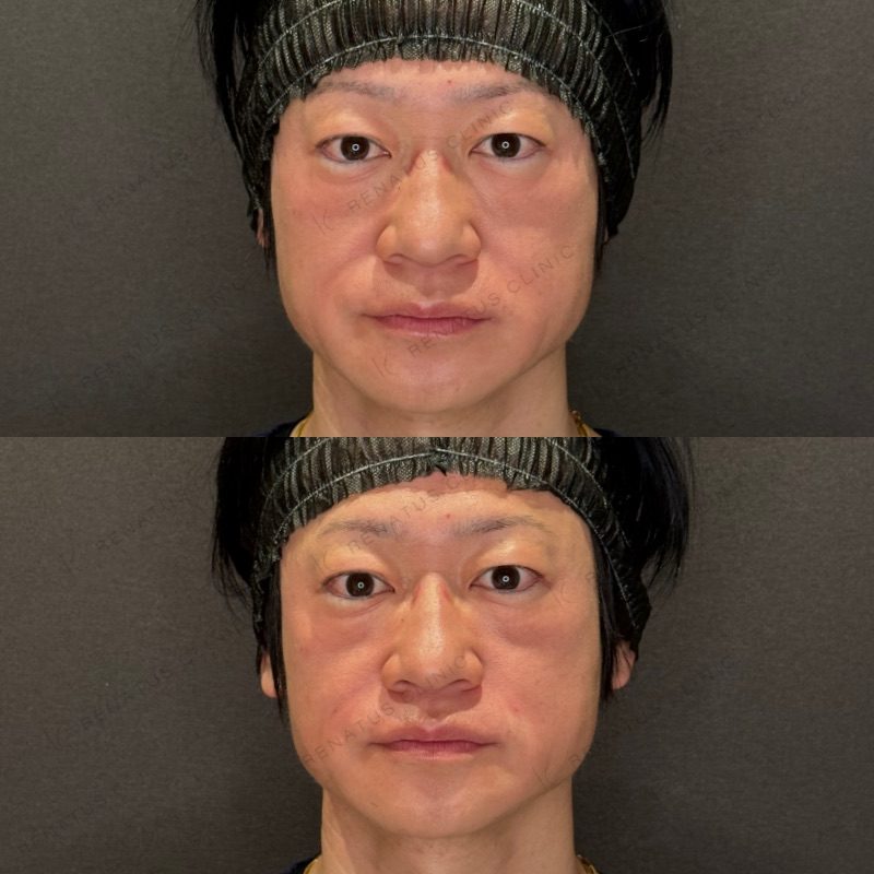 ほうれい線ヒアルロン酸の症例（ボリフト・40代男性）。注入前と注入後の比較