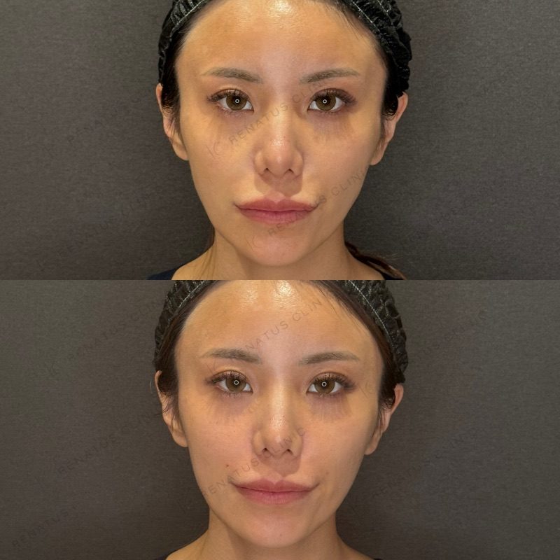 ほうれい線ヒアルロン酸の症例（ボリフト・20代女性）。注入前と注入後の比較