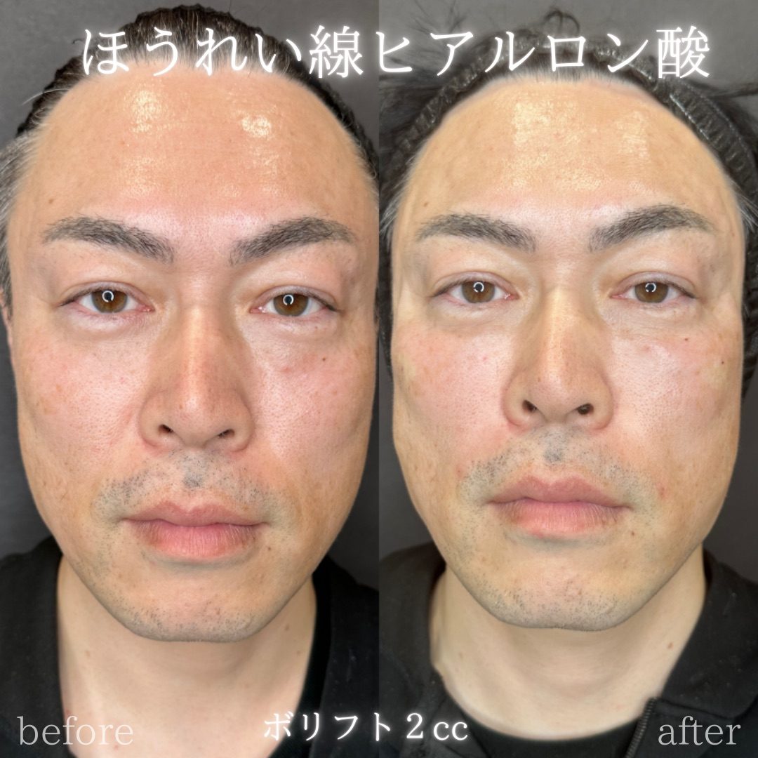 ほうれい線ヒアルロン酸の症例（ボリフト・40代男性・大阪）。注入前と注入後の比較