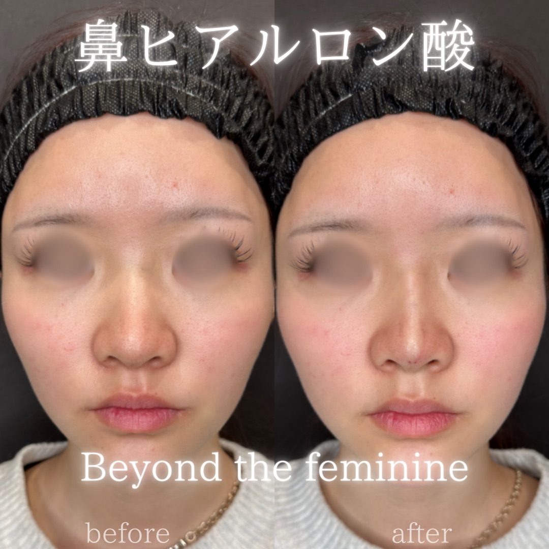 鼻ヒアルロン酸の症例（ボラックス・20代女性）。注入前と注入後の比較
