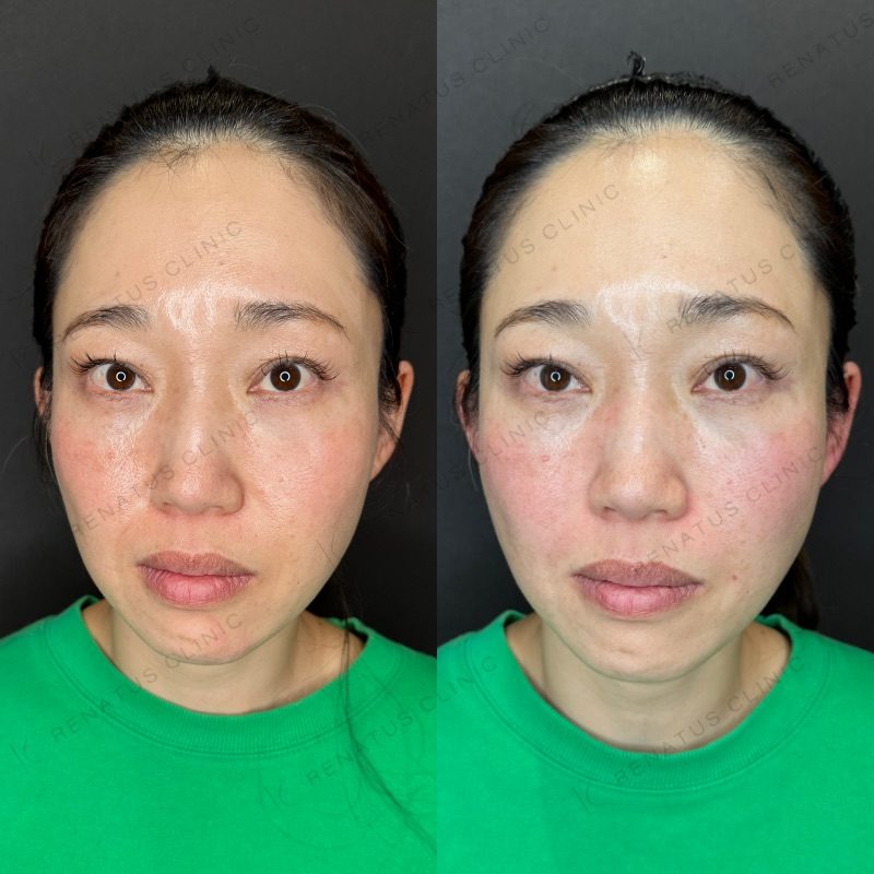 ほうれい線ヒアルロン酸の症例（ボリフト・40代女性・大阪）。注入前と注入後の比較