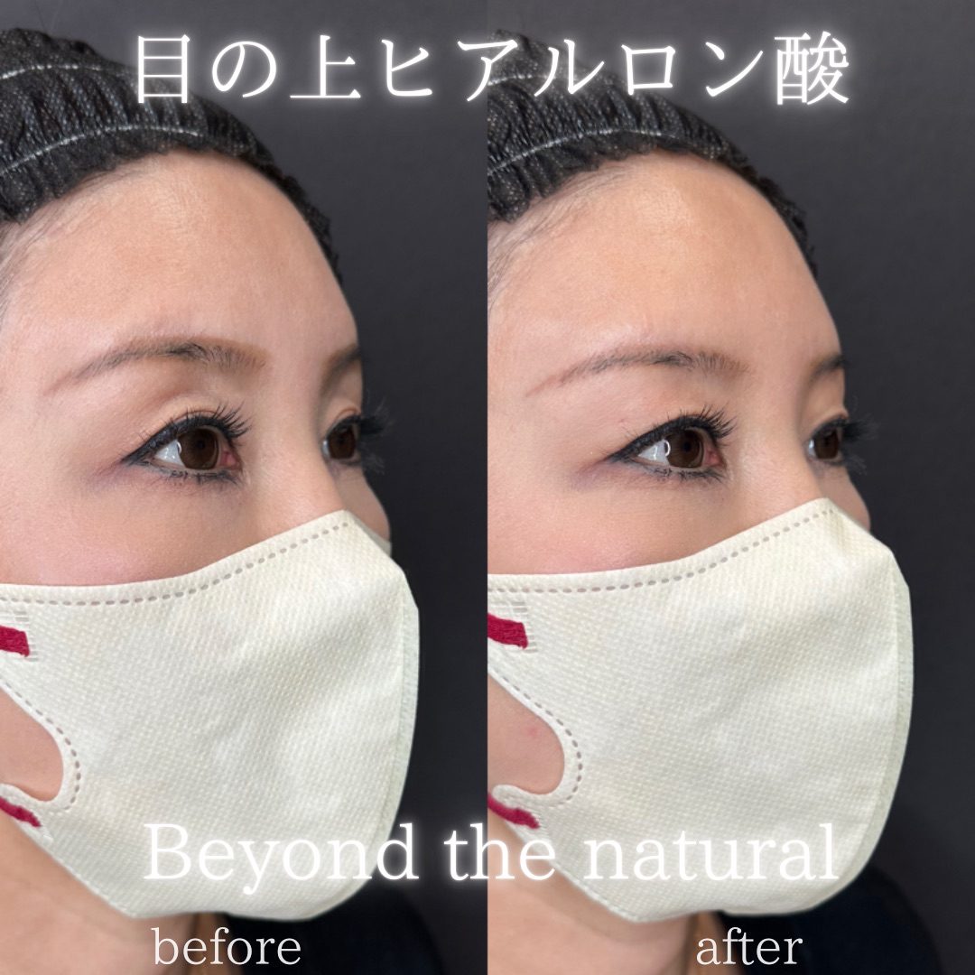 目の上（目のくぼみ）ヒアルロン酸の症例（ボルベラ・40代女性）。注入前と注入後の比較