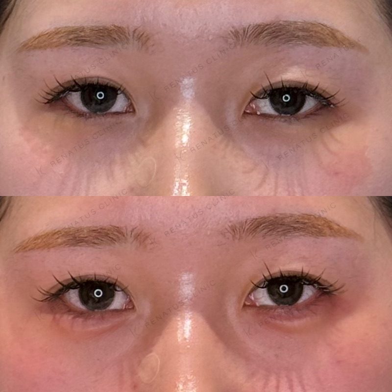 仙台の涙袋ヒアルロン酸が上手い先生・名医と安いおすすめのクリニック 60 涙袋のヒアルロン酸の症例(注入前と注入後)