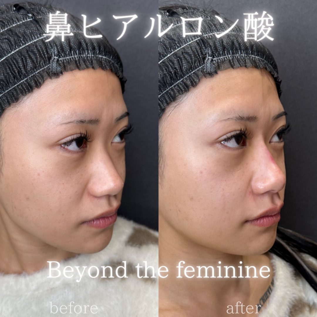 鼻ヒアルロン酸の症例（ボラックス・20代女性）。注入前と注入後の比較