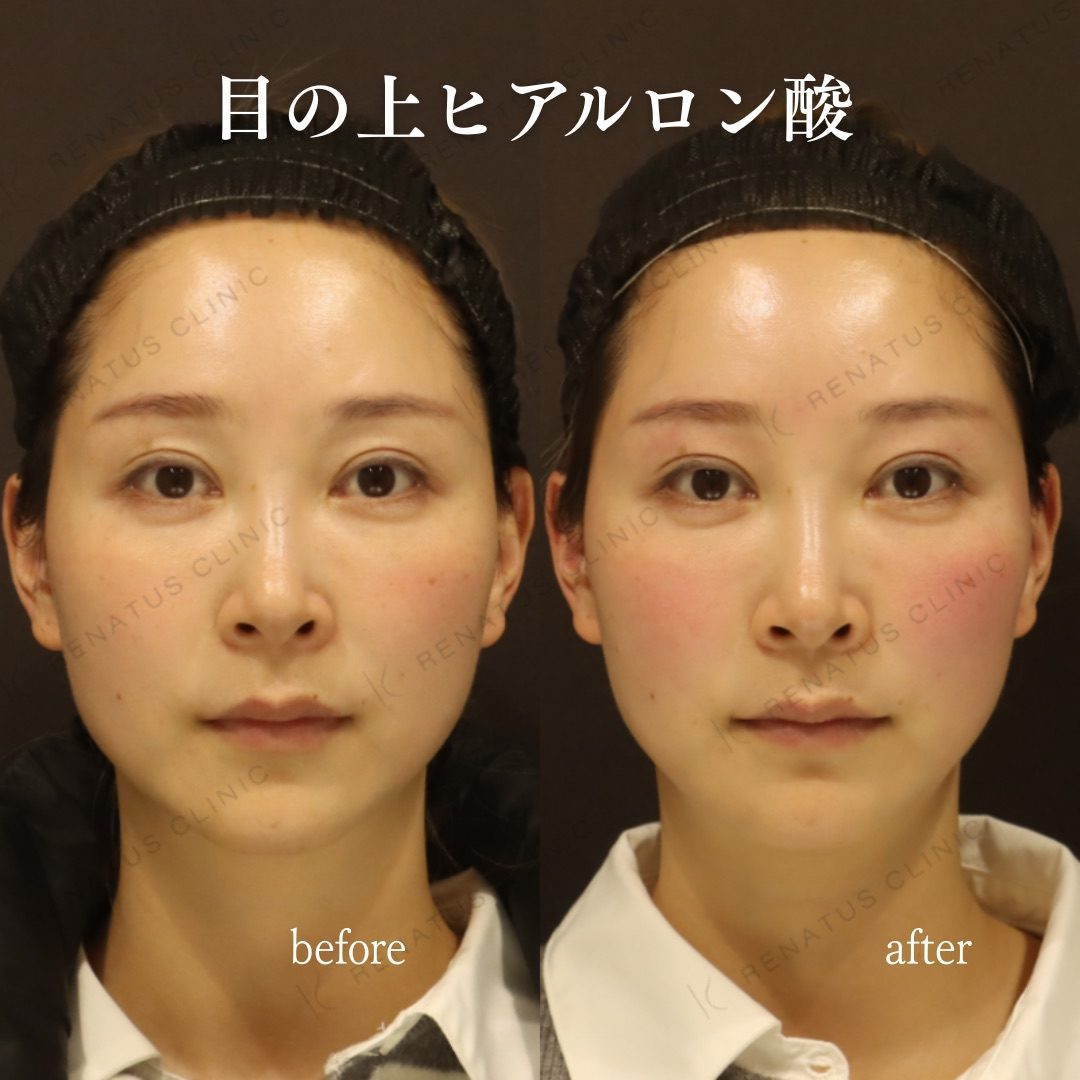 目のくぼみ・目の上のくぼみ ヒアルロン酸の費用・何cc・持ち|名医の選び方 54 目の上(目のくぼみ)ヒアルロン酸の症例(ボルベラ・30代)。注入前と注入後の比較