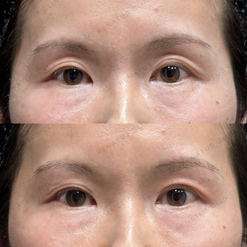 目のくぼみ・目の上のくぼみ ヒアルロン酸の費用・何cc・持ち|名医の選び方 53 目の上(目のくぼみ)ヒアルロン酸の症例(ボルベラ・40代女性)。注入前と注入後の比較