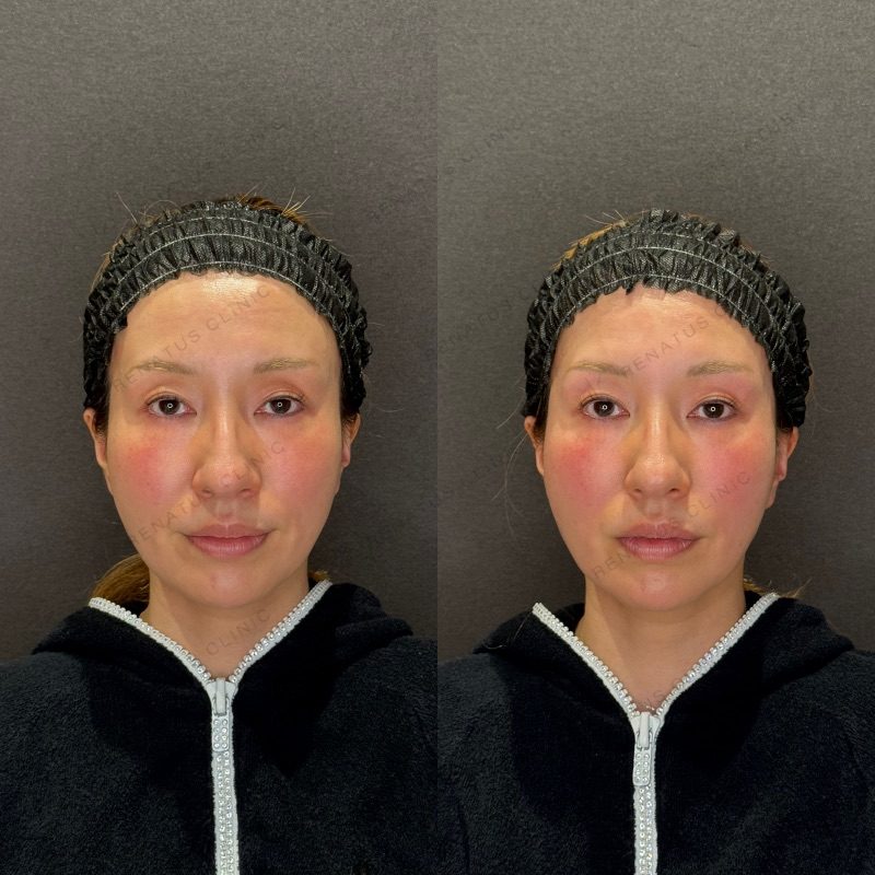 目のくぼみ ヒアルロン酸 名医 名古屋|症例・費用・失敗しないために【公式】 20 目の上(目のくぼみ)ヒアルロン酸の症例(ボルベラ・30代女性)。注入前と注入後の比較