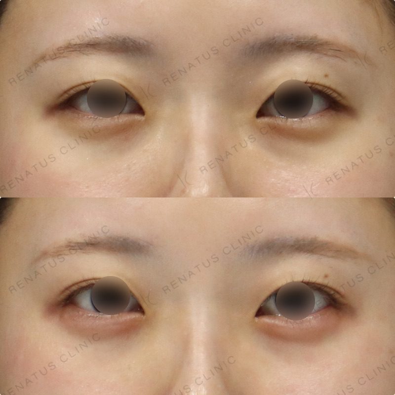 仙台の涙袋ヒアルロン酸が上手い先生・名医と安いおすすめのクリニック 57 涙袋のヒアルロン酸の症例(注入前と注入後)