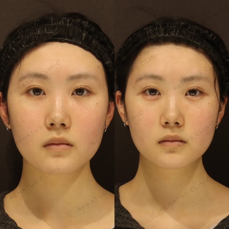 仙台の涙袋ヒアルロン酸が上手い先生・名医と安いおすすめのクリニック 54 涙袋のヒアルロン酸の症例(注入前と注入後)