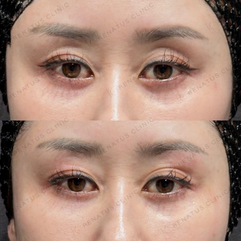 目のくぼみ・目の上のくぼみ ヒアルロン酸の費用・何cc・持ち|名医の選び方 49 目の上(目のくぼみ)ヒアルロン酸の症例(ボルベラ・40代女性)。注入前と注入後の比較