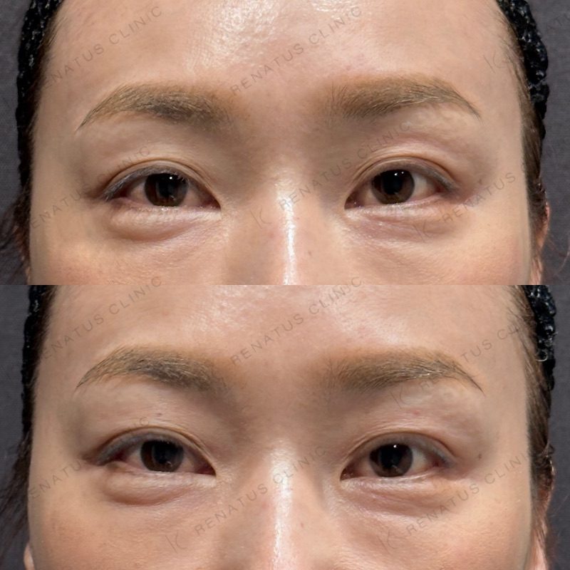 目のくぼみ・目の上のくぼみ ヒアルロン酸の費用・何cc・持ち|名医の選び方 47 目の上(目のくぼみ)ヒアルロン酸の症例(ボルベラ・40代女性)。注入前と注入後の比較