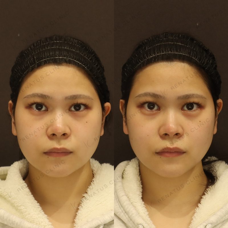 仙台の涙袋ヒアルロン酸が上手い先生・名医と安いおすすめのクリニック 40 涙袋のヒアルロン酸の症例(注入前と注入後)