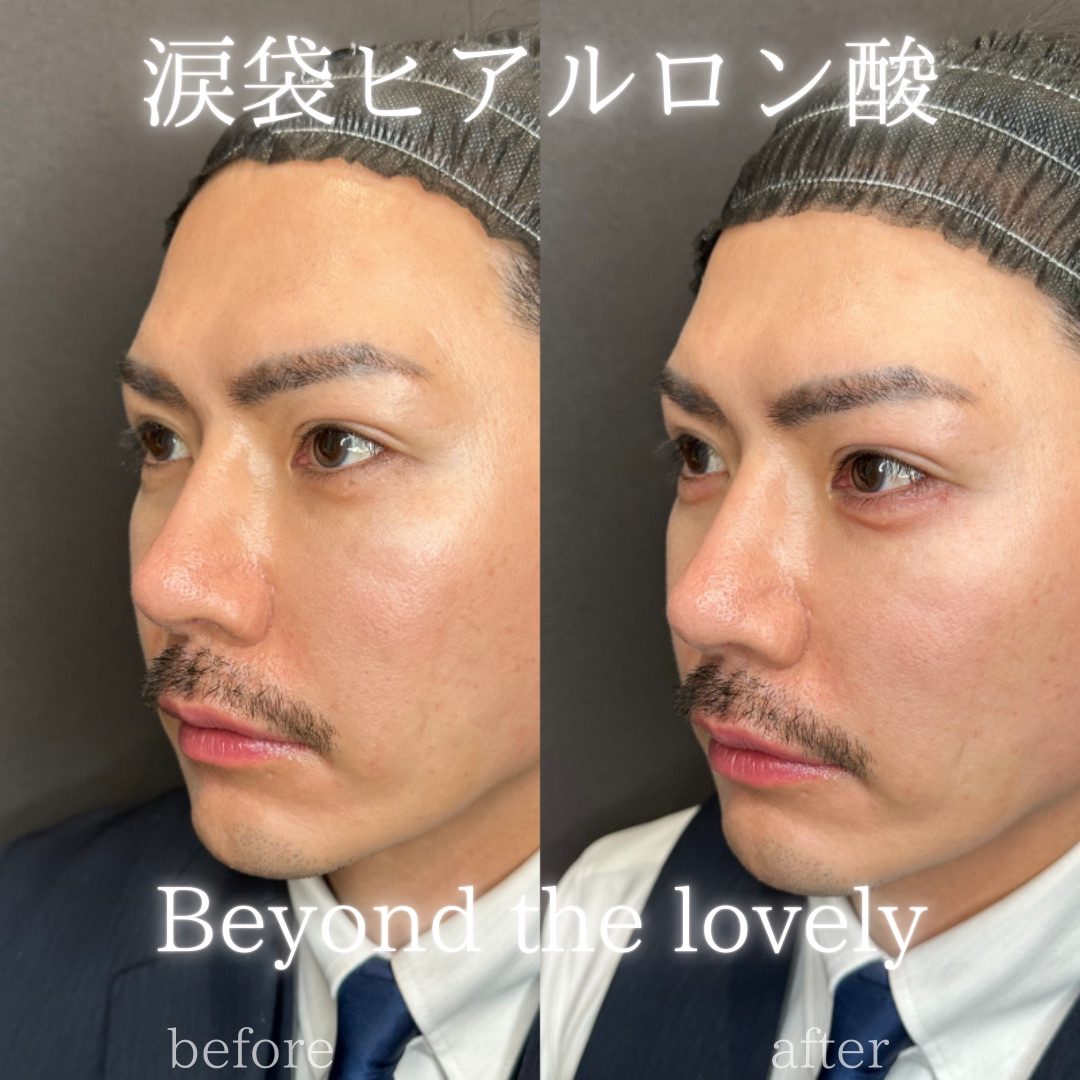 仙台の涙袋ヒアルロン酸が上手い先生・名医と安いおすすめのクリニック 36 涙袋のヒアルロン酸の症例(注入前と注入後)