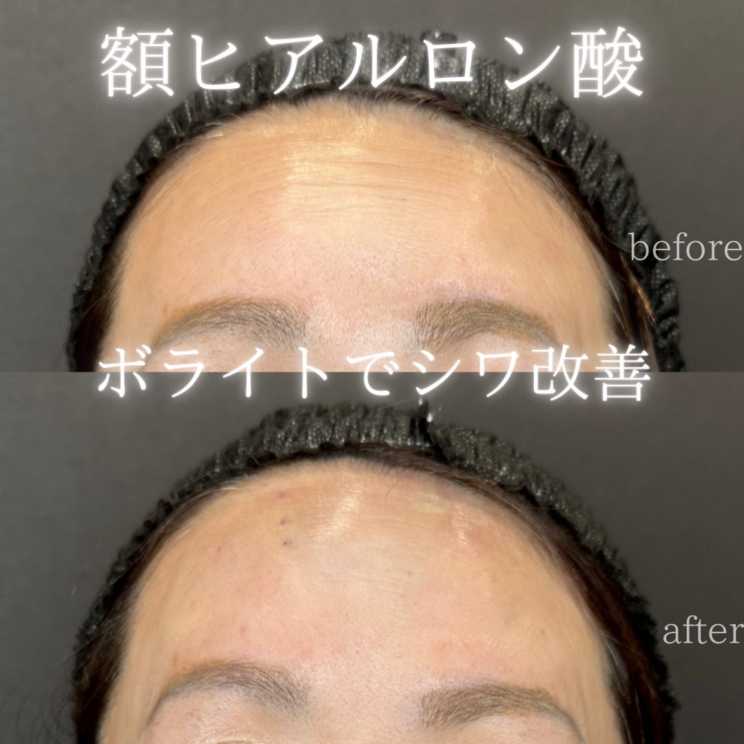 額 ヒアルロン酸・おでこ ヒアルロン酸の値段・何cc・持ち・失敗【公式】 12 額ヒアルロン酸(ボライト)の症例(ボライト・50代女性)。注入前と注入後の比較