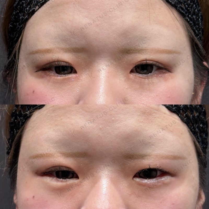 仙台の涙袋ヒアルロン酸が上手い先生・名医と安いおすすめのクリニック 34 涙袋のヒアルロン酸の症例(注入前と注入後)