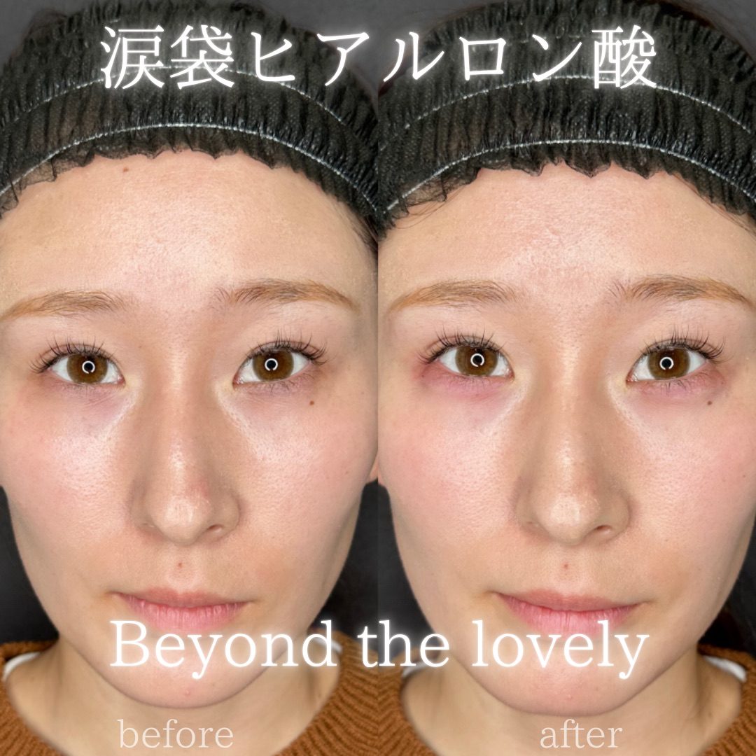 仙台の涙袋ヒアルロン酸が上手い先生・名医と安いおすすめのクリニック 30 涙袋のヒアルロン酸の症例(注入前と注入後)
