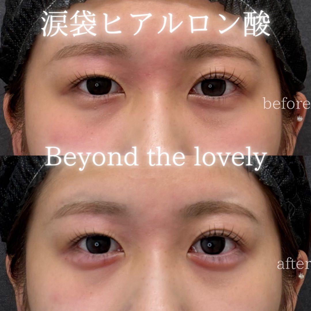 仙台の涙袋ヒアルロン酸が上手い先生・名医と安いおすすめのクリニック 29 涙袋のヒアルロン酸の症例(注入前と注入後)