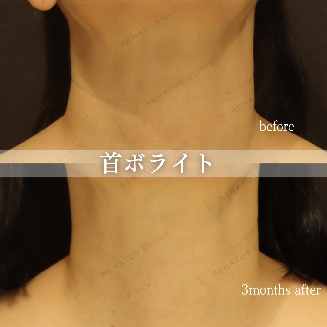 首のシワ改善・ヒアルロン酸注入なら レナトゥスクリニック 8 首のヒアルロン酸(ボライト)の症例(ボライト・50代女性)。注入前と注入後の比較