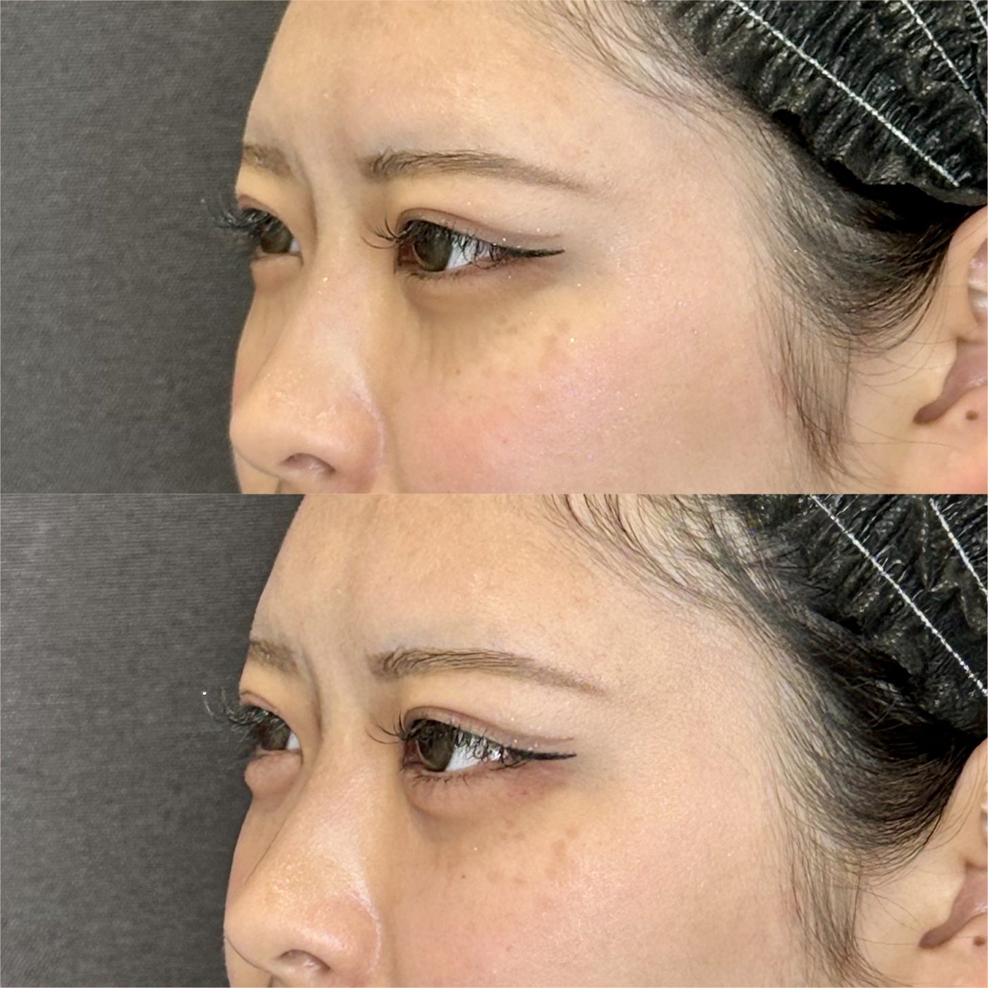仙台の涙袋ヒアルロン酸が上手い先生・名医と安いおすすめのクリニック 25 涙袋のヒアルロン酸の症例(注入前と注入後)